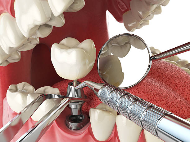 Best Emergency Tooth Extraction in Peoria Heights, IL